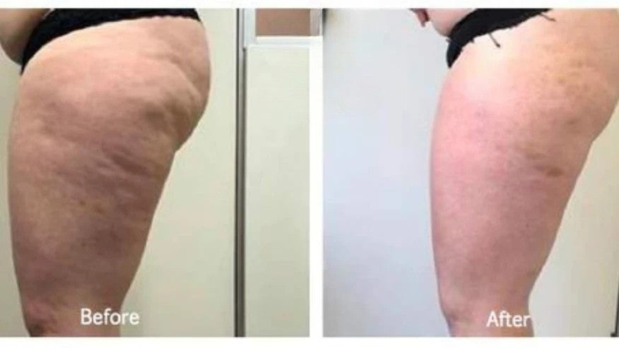 3 in 1 Cavitation Slimming Machine