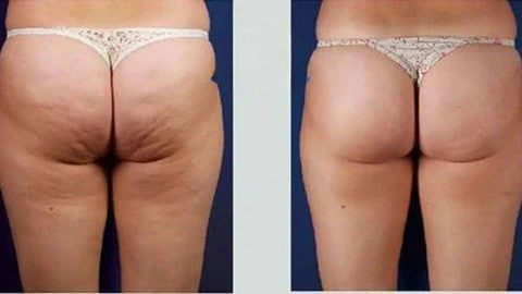 3 in 1 Cavitation Slimming Machine